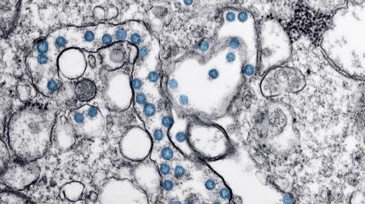 CDC/Hannah A Bullock/Azaibi Tami A digitally-enhanced microscopic image shows a coronavirus infection in blue of the first case discovered in the United States.